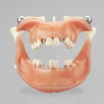Comprehensive Implant Counseling Model [PE-IMP007]