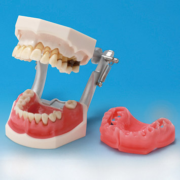 Periodontal Disease Model with Tooth  Mobility [PE-PER003]