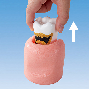 Periodontal Disease Model [PE-PER014]