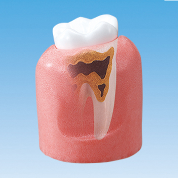Periodontal Disease Model [PE-PER014]