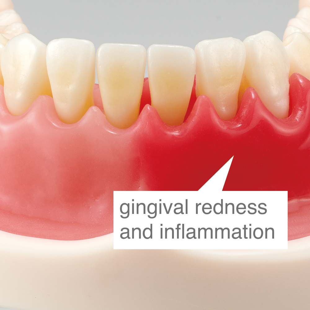 Periodontal Disease/ Peri-Implant Disease Model [PE-PER015]