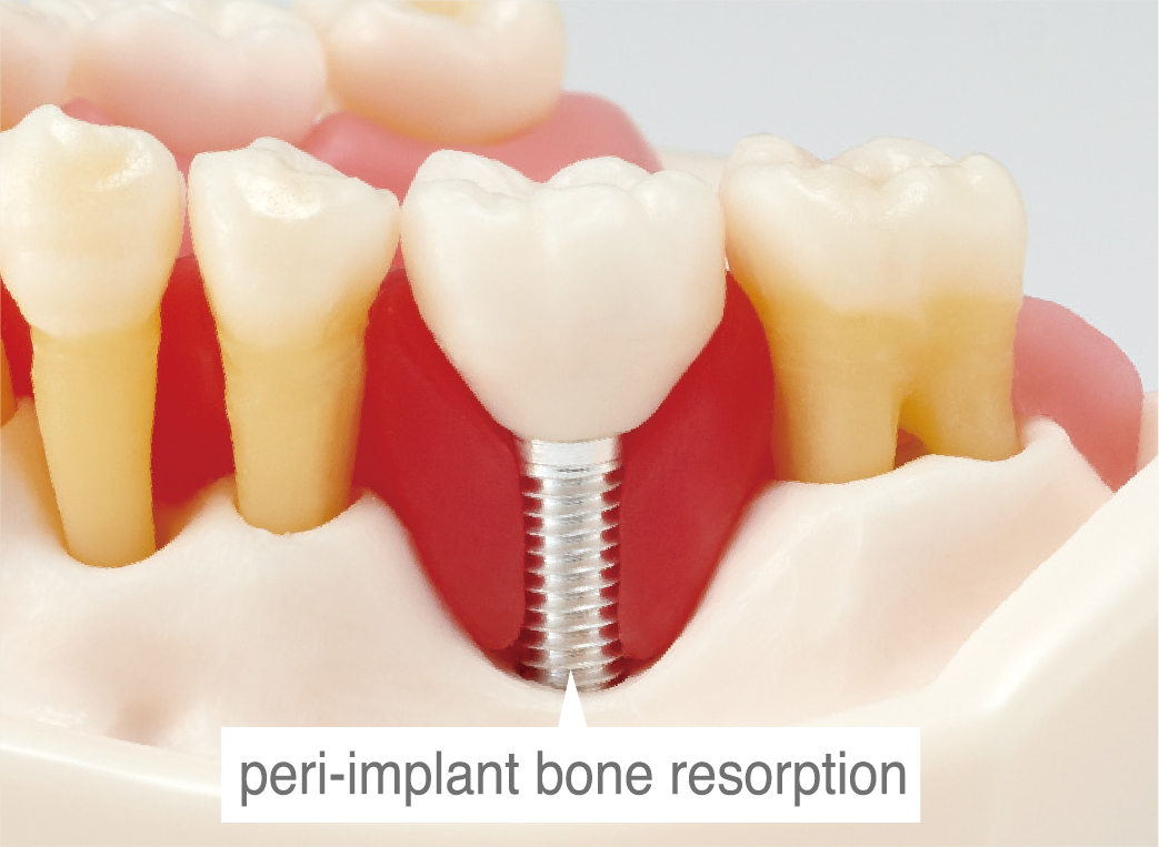 Periodontal Disease/ Peri-Implant Disease Model [PE-PER015]