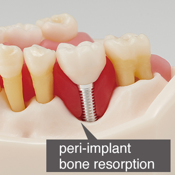 Periodontal Disease/ Peri-Implant Disease Model [PE-PER015]