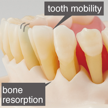 Periodontal Disease/ Peri-Implant Disease Model [PE-PER015]