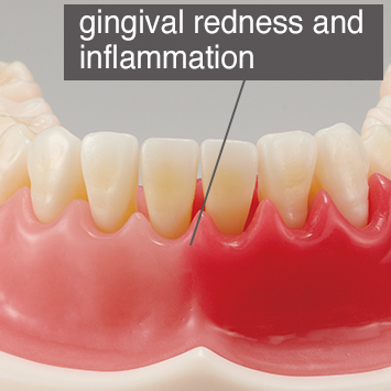 Periodontal Disease/ Peri-Implant Disease Model [PE-PER015]