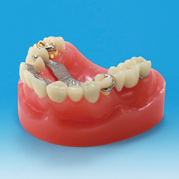 Dental Restoration/Implant  Restoration Prosthesis Study Model [PE-PRO002]