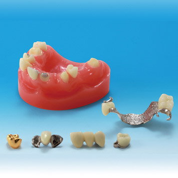 Dental Restoration/Implant  Restoration Prosthesis Study Model [PE-PRO002]