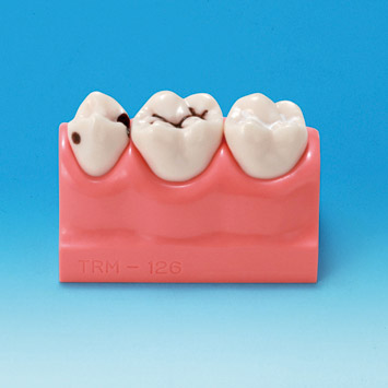 Caries Prevention Model [PE-STP008]