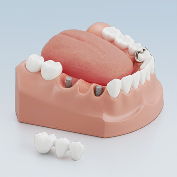 Prosthesis Care & Brushing Model [PE-STP011]