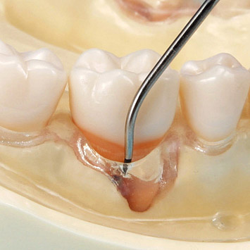 SRP Jaw Model [PER2001-UL-SC-FEM-32]