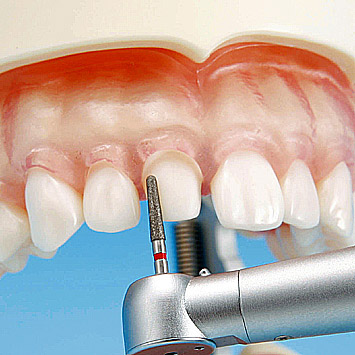 Prosthetic Restoration Jaw Model (32 teeth) [PRO2001-UL-SCP-FEM-32]