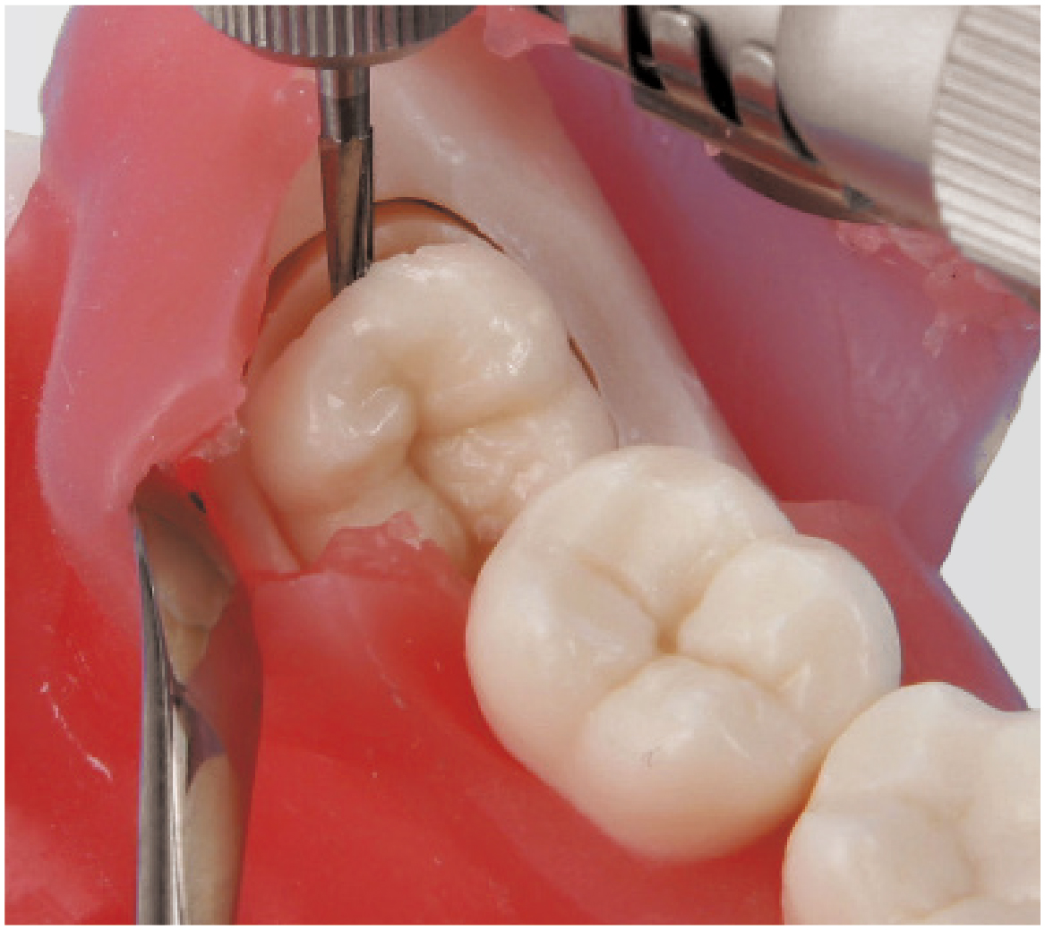 Impacted Tooth Exteaction Model [SUG1010-T-SP]