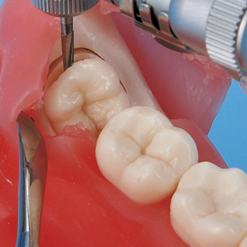 Impacted Tooth Exteaction Model [SUG1010-T-SP]