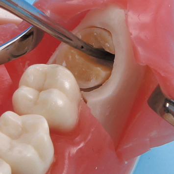 Impacted Tooth Exteaction Model [SUG1010-T-SP]