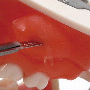 Incision/Pus Removal Model [SUG2001-UL-SP-FEM-28]