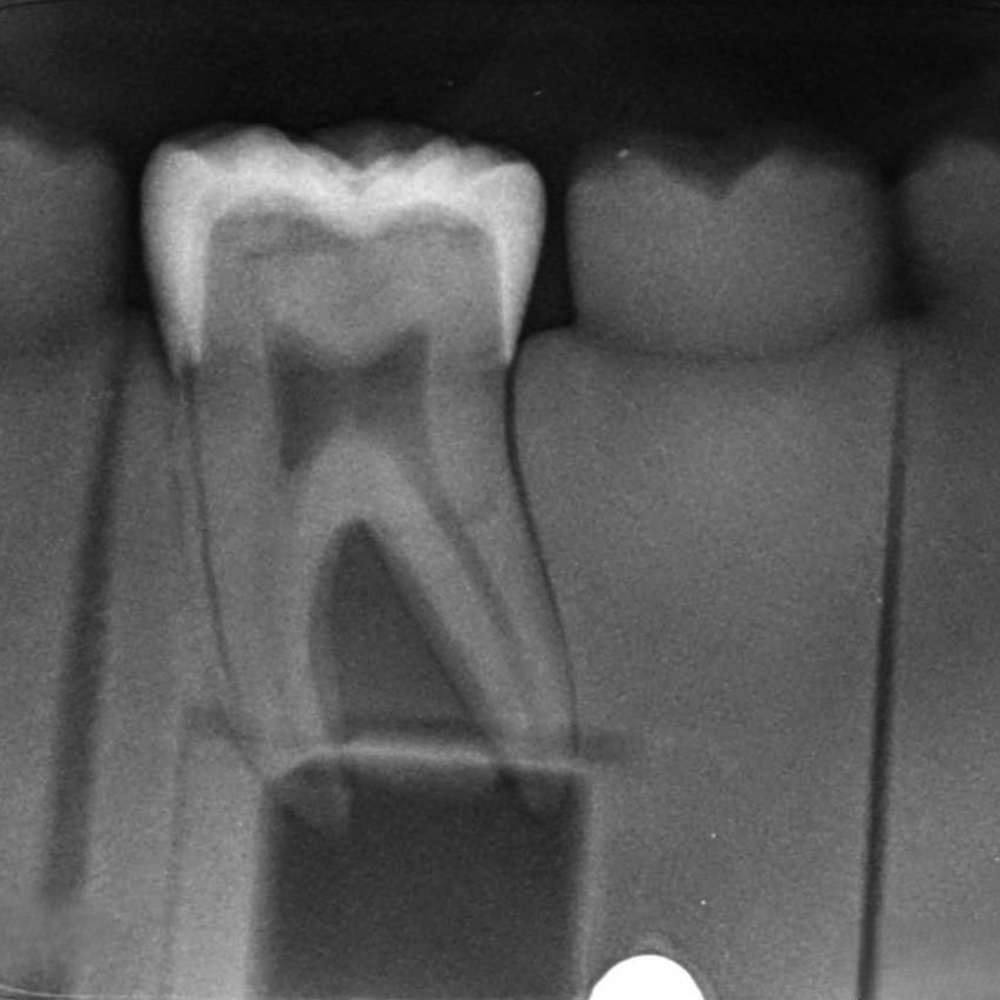 Endodontic Training Jaw Model [CON7002-UL-HD-HM]