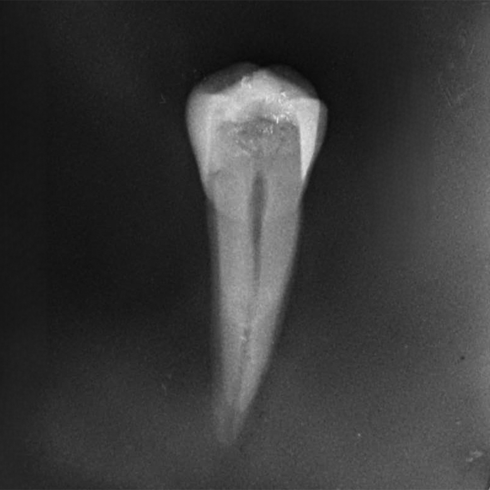 Endodontic Training Jaw Model [CON7002-UL-HD-HM]