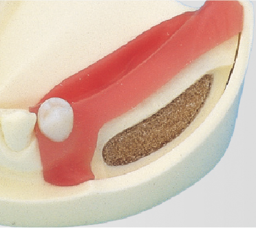 Modelo para Práctica de Implantes [IMP1001-UL-SP-FEM]