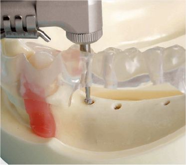 Modelo para Práctica de Implantes [IMP1001-UL-SP-FEM]