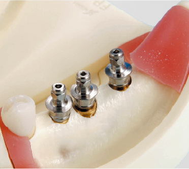 Modelo para Práctica de Implantes [IMP1001-UL-SP-FEM]