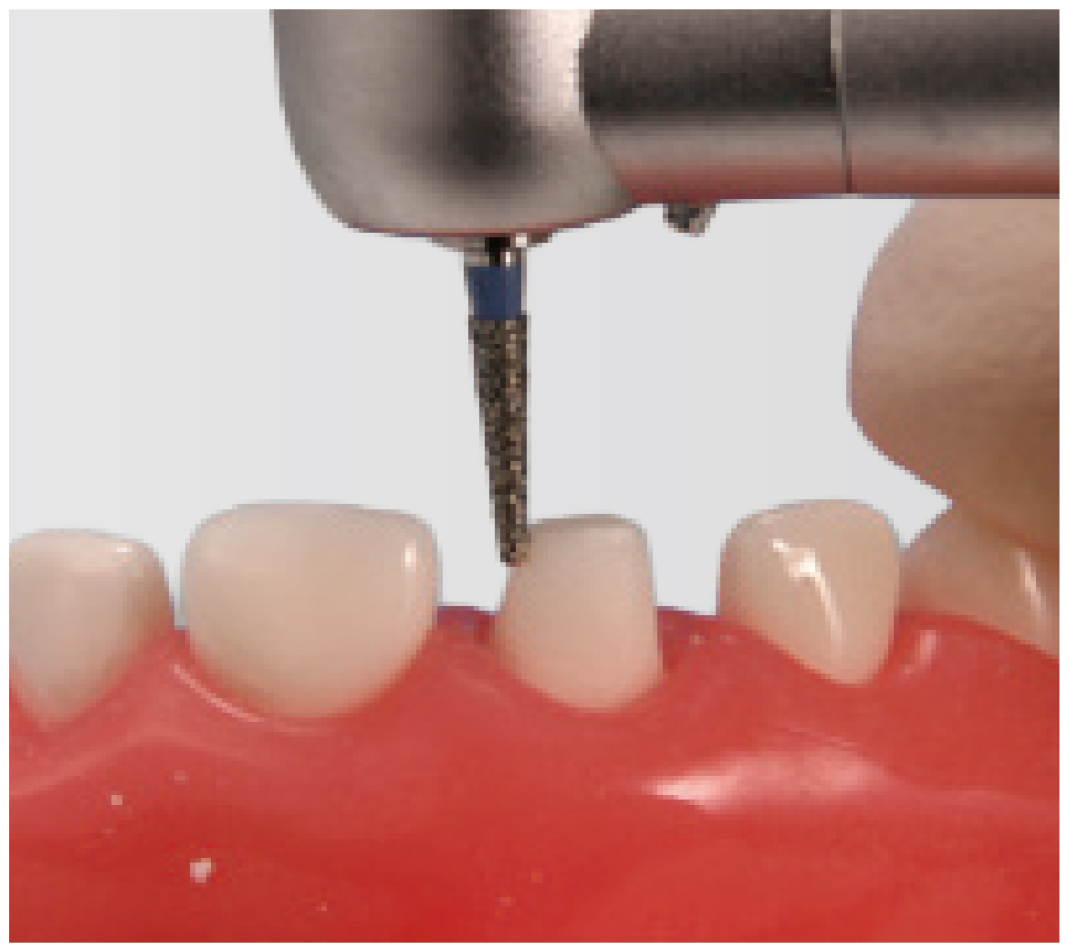 Modelo de Maxilar con Encía Blanda (Dentición Mixta) [PDI2001-UL-SP-FEM]