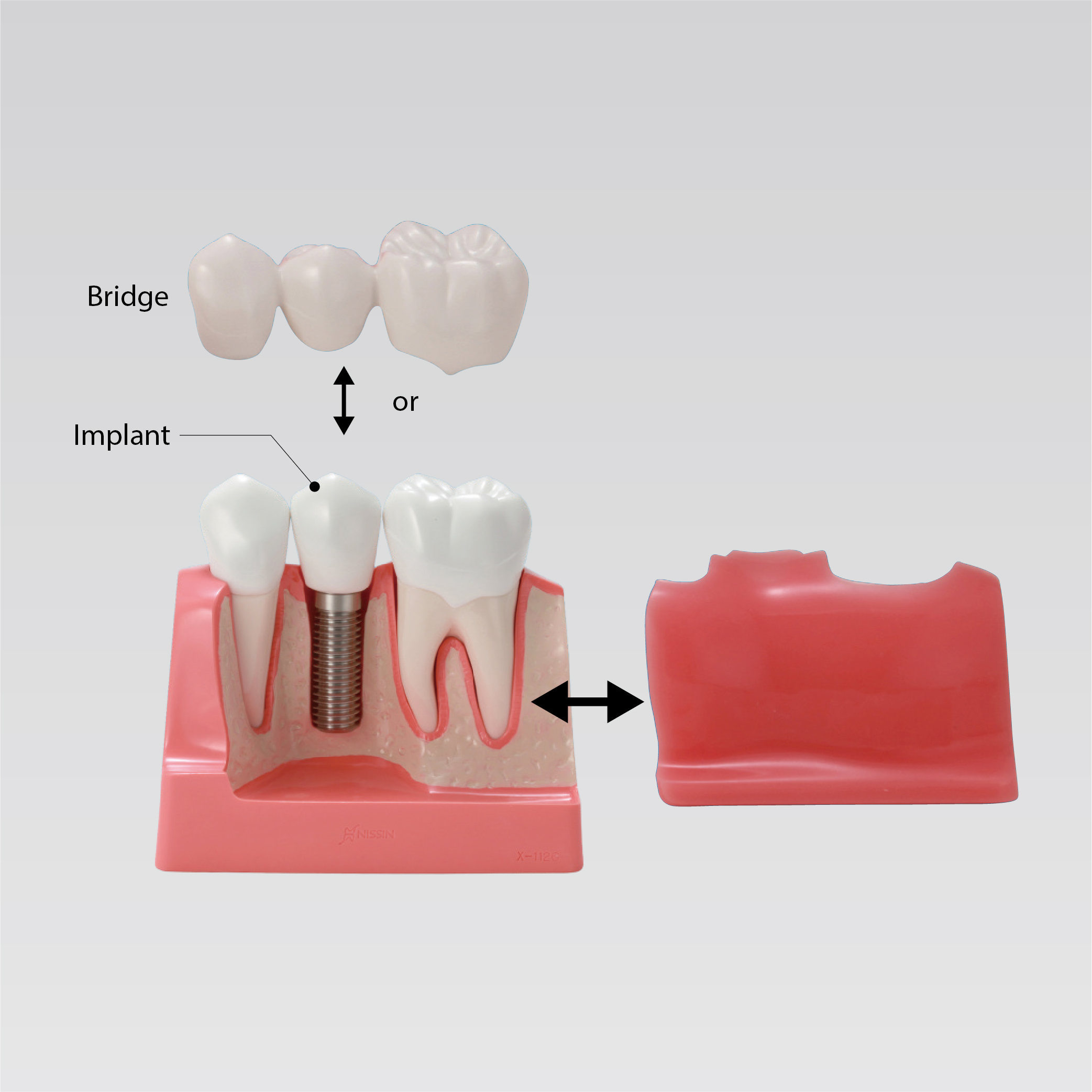 Modelo Comparativo de Implantes y Puentes [PE-IMP001]