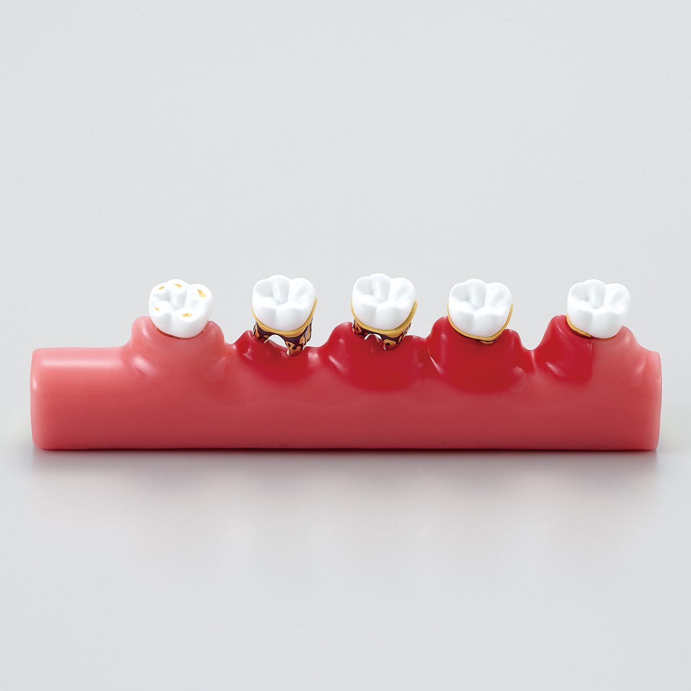 Modelo de Enfermedad Periodontal [PE-PER010]