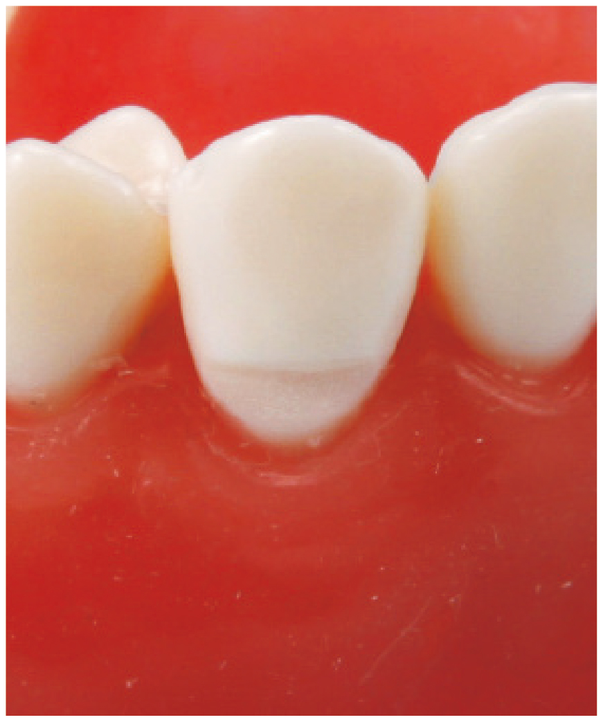 Modelo de Diente con Defecto en Forma de Cuña [A25A-UL39B (#23)] [A25A-UR39E (#13)] [A25A-UR49J (#14)]