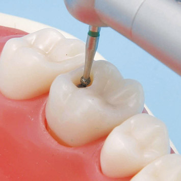 Modelo de Diente con Caries [Serie A27AN]