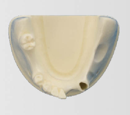 Modelo de Práctica de Injerto Oseo [IMP1009-L-SP]