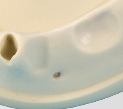 Modelo de Práctica de Injerto Oseo [IMP1009-L-SP]