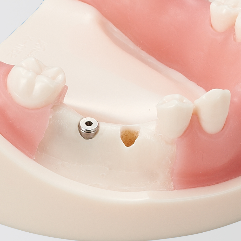 Modelo Básico para Práctica de Implantes [Serie IMP1034]