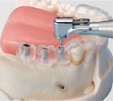 Modelo Básico para Práctica de Implantes [Serie IMP5003]