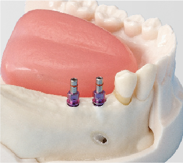 Modelo Básico para Práctica de Implantes [Serie IMP5003]