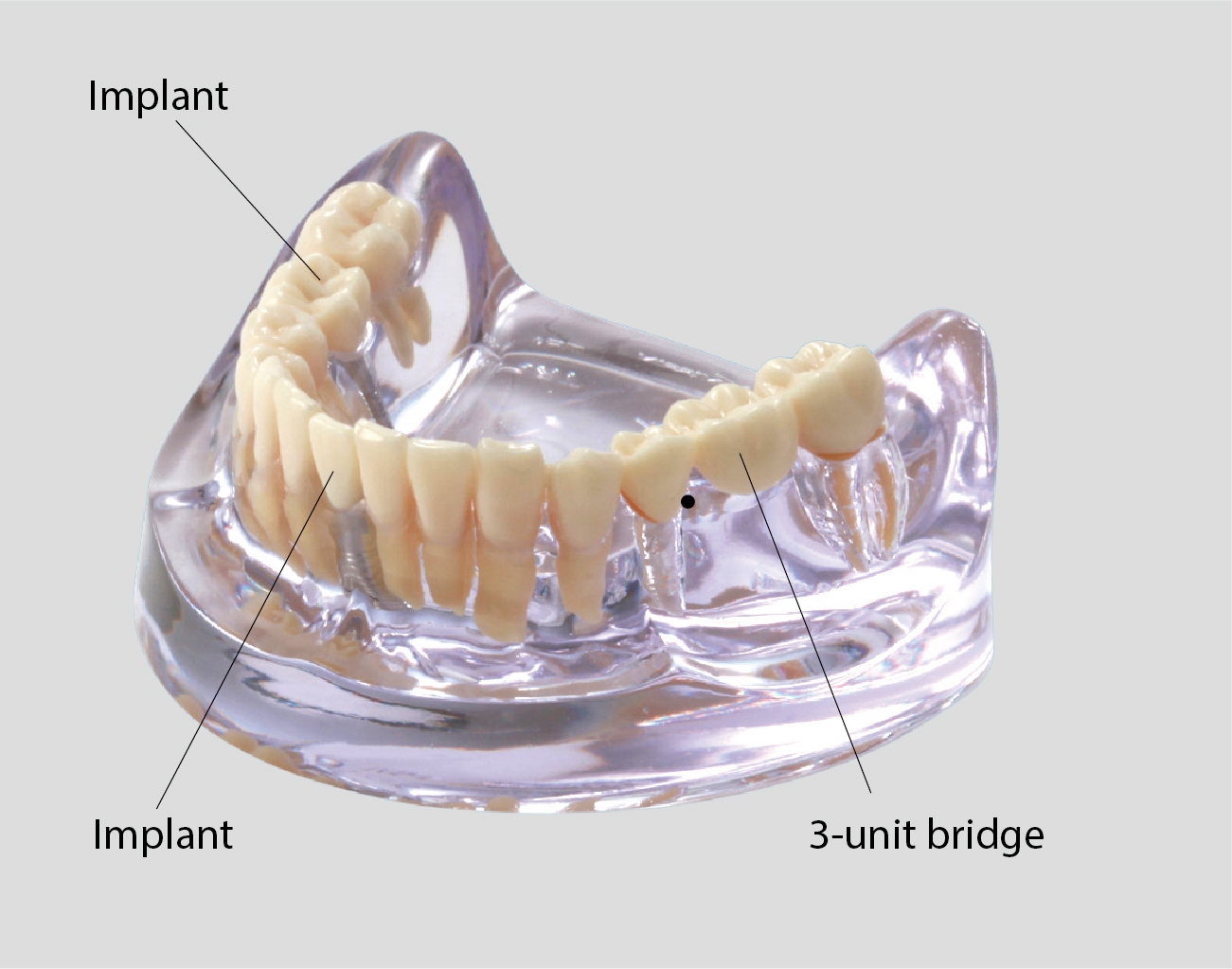 Modelo Comparativo de Implantes y Puentes [PE-IMP003]