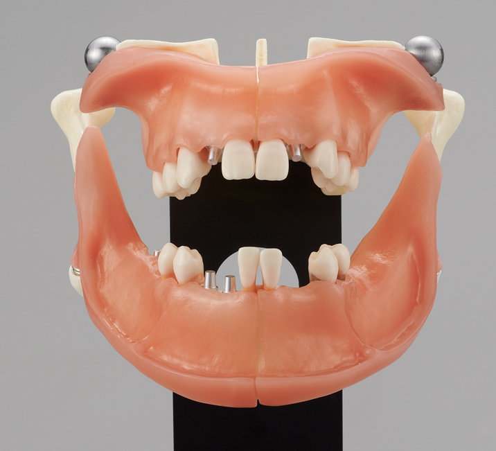 Modelo Extensivo para Asesoría sobre Implantes [PE-IMP007]