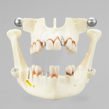 Modelo Extensivo para Asesoría sobre Implantes [PE-IMP007]