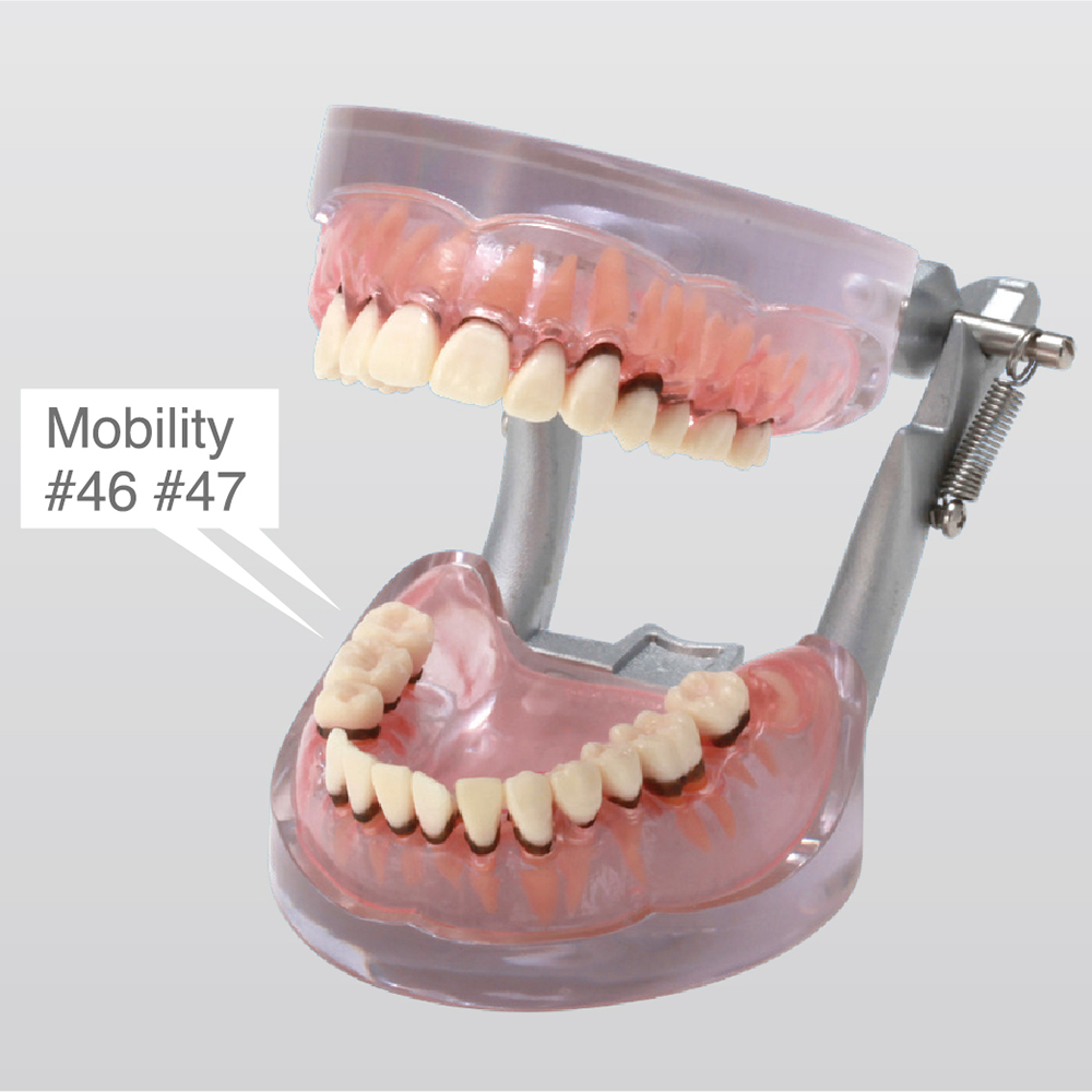 Modelo de Enfermedad Periodontal [PE-PER004]