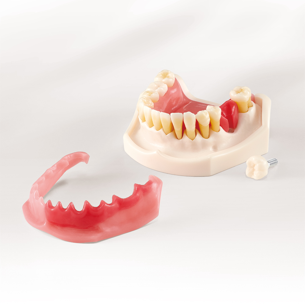 Modelo de Enfermedad periodontal y Peri-implantitis [PE-PER015]