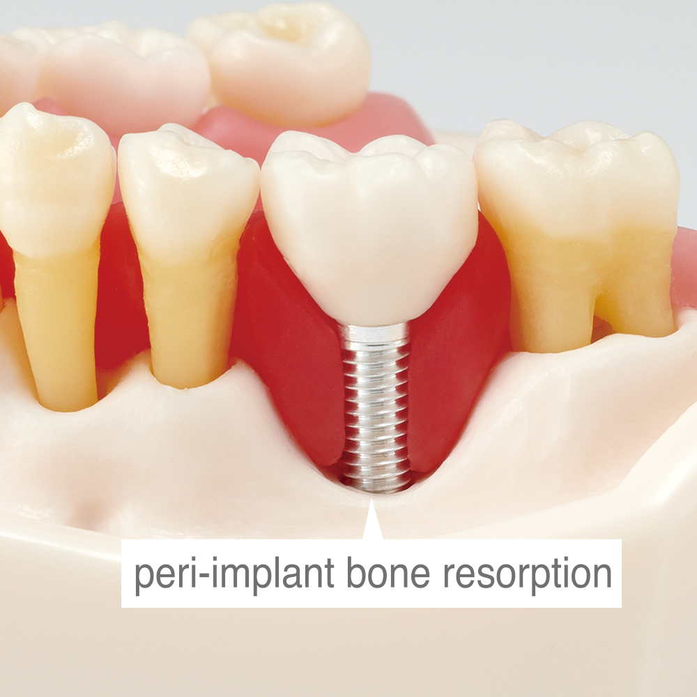 Modelo de Enfermedad periodontal y Peri-implantitis [PE-PER015]