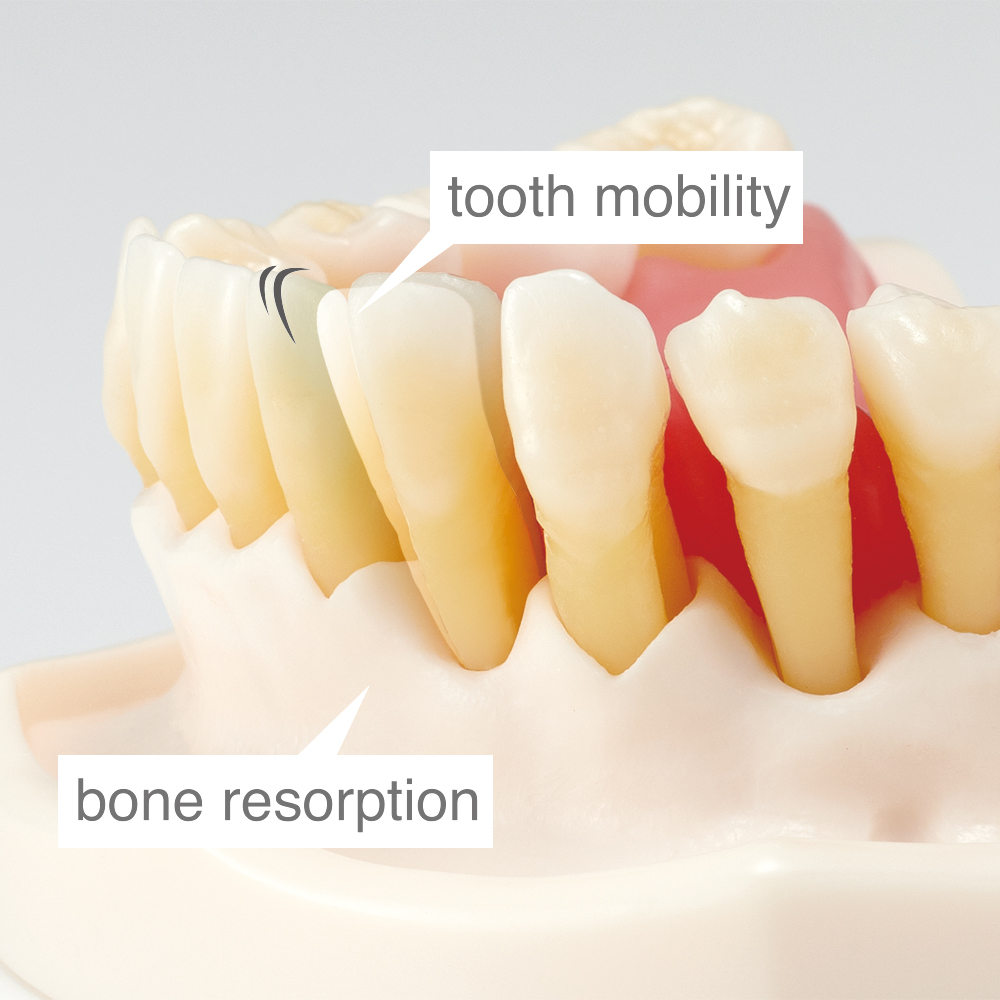 Modelo de Enfermedad periodontal y Peri-implantitis [PE-PER015]