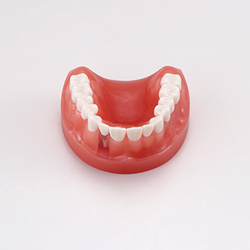 Modelo de Restauraciones Dentales Estéticas [PE-PRO020]