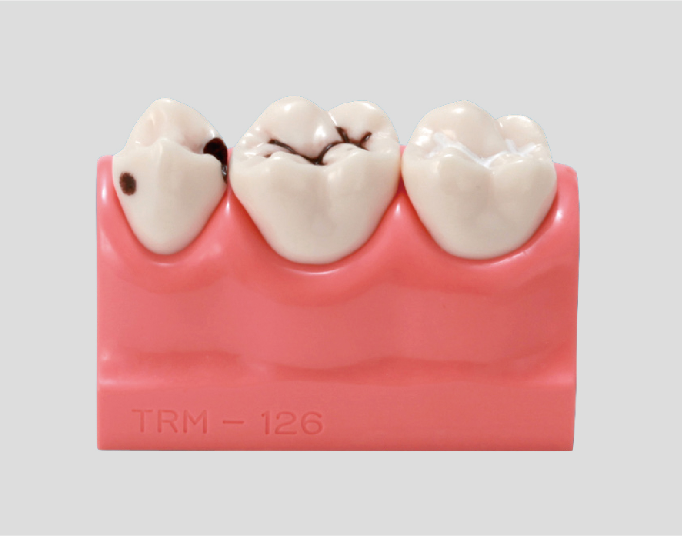 Modelo Prevención de Caries [PE-STP008]
