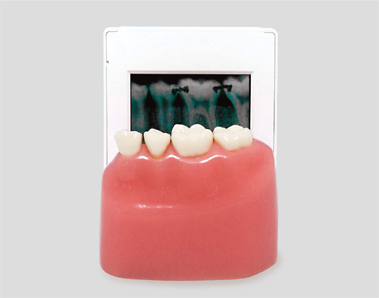 Modelo de Detección de Caries por Rayos X [PE-STP009]