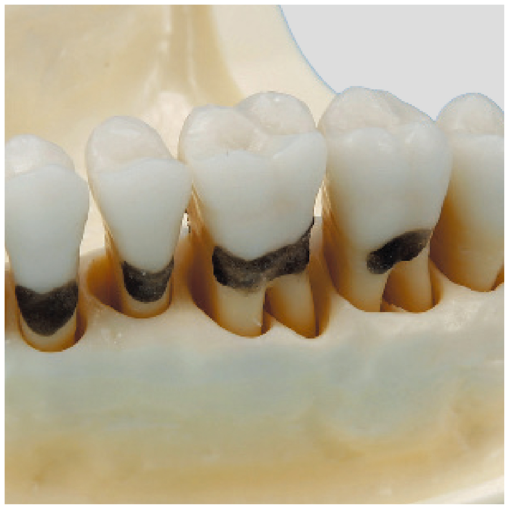 Modelo de Maxilar para Periodoncia [PER1001-UL-SP-FEM-32]