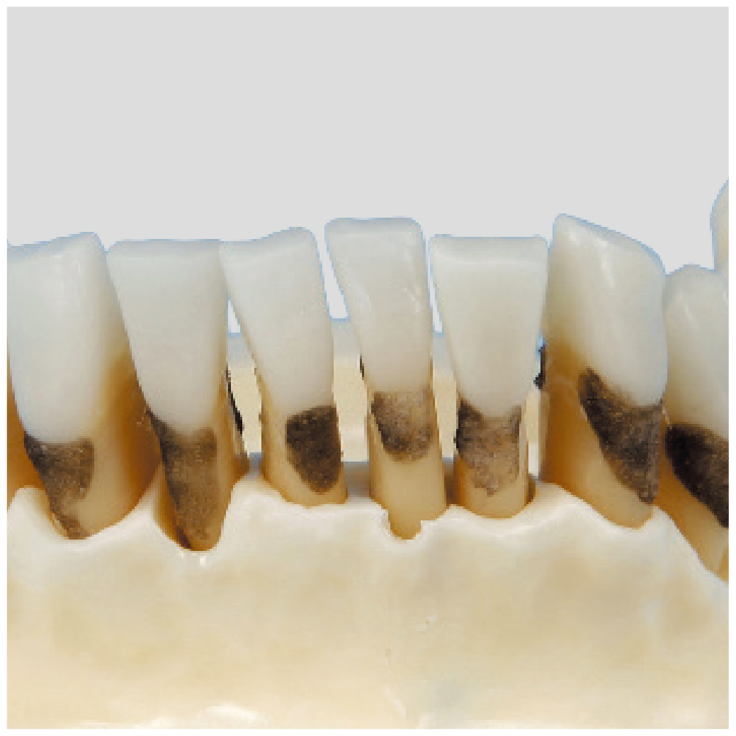 Modelo de Maxilar para Periodoncia [PER1001-UL-SP-FEM-32]