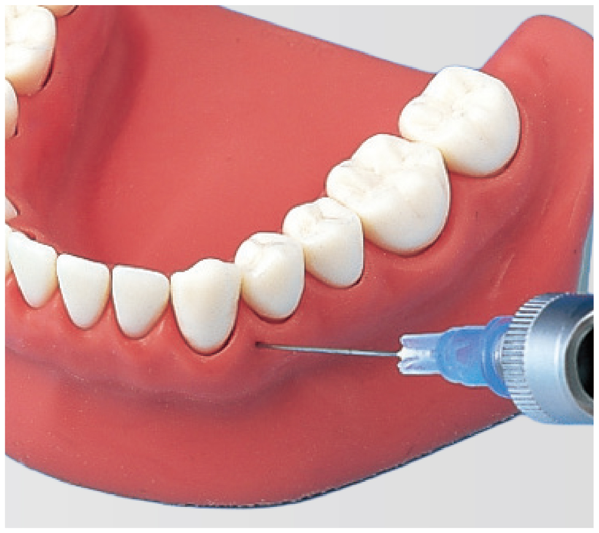 Modelo de Maxilar para Anestesia por Infiltración [SUG1004-UL-SP-FEM-28]