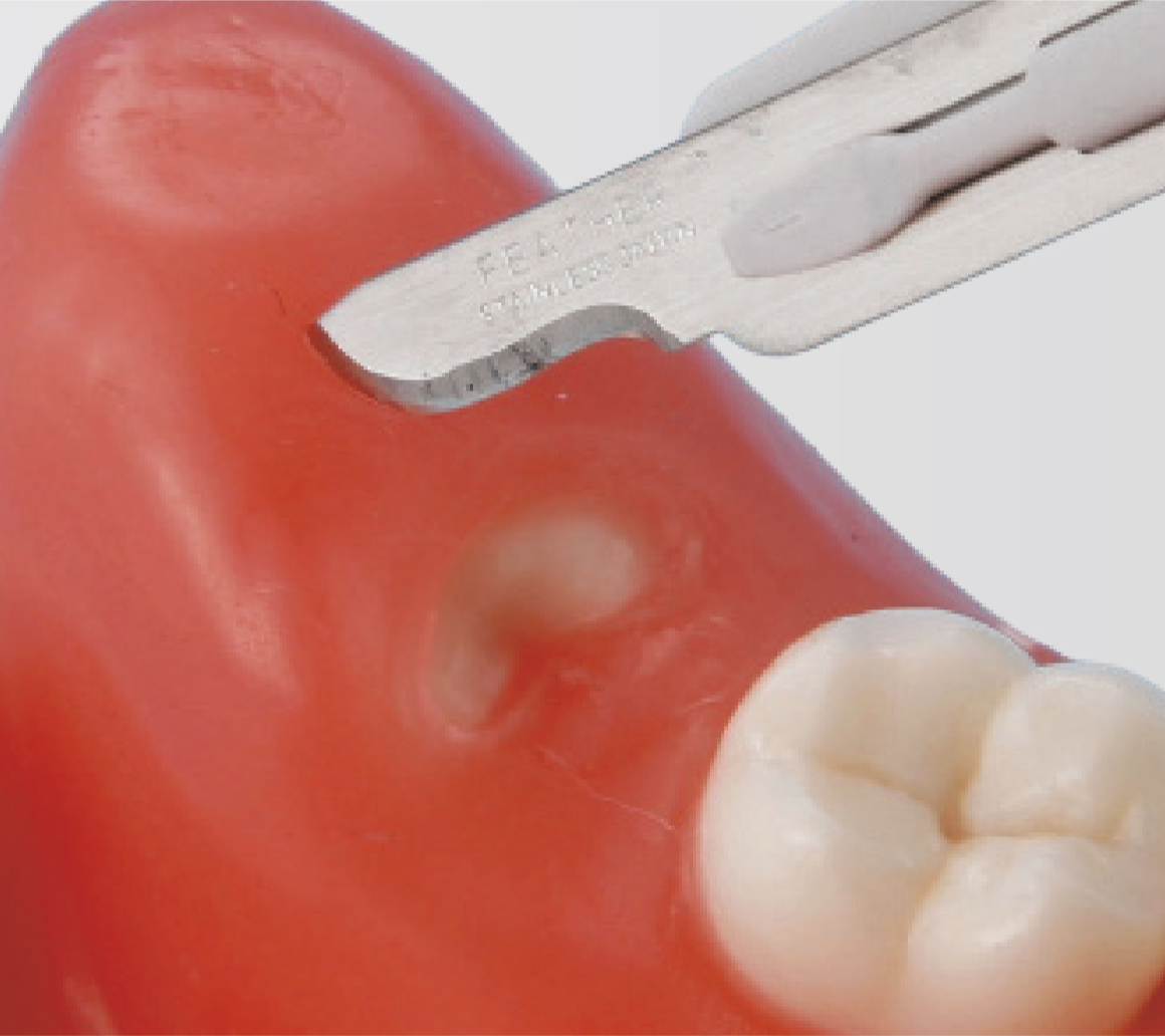 Modelo de Extracción de Diente Impactado [SUG1010-T-SP]