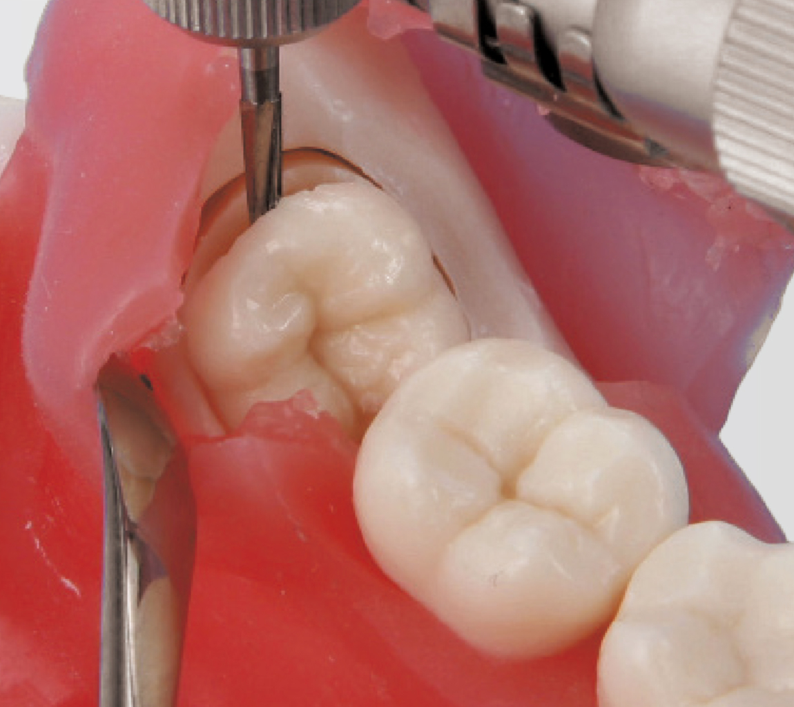 Modelo de Extracción de Diente Impactado [SUG1010-T-SP]