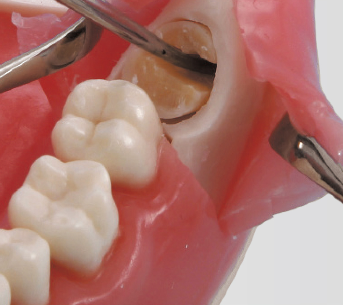 Modelo de Extracción de Diente Impactado [SUG1010-T-SP]